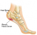 Foot with Plantar Fascitis