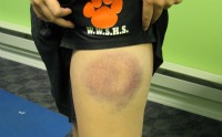 Bruise Before Treatment