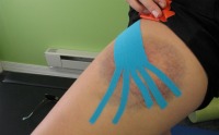 Bruise With Kinesio Tape