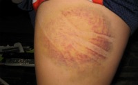 Bruise After Treatment